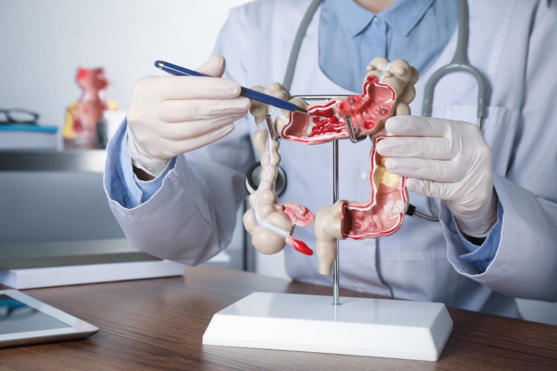 Spotting the Early Signs of Colorectal Cancer